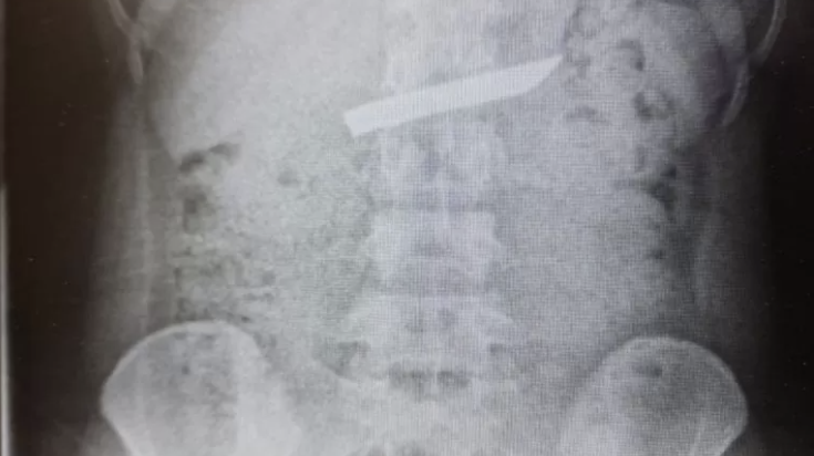 צילום רנטגן, להב הסכין בבטן העליונה| (צילום: דוברות המרכז הרפואי לגליל)
