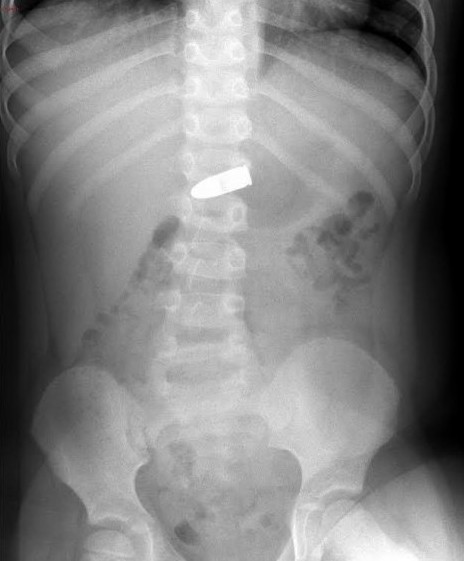 צילום הרנטגן בו נראה קליע האקדח בבטנו של הילד (צילום: מרכז שניידר)