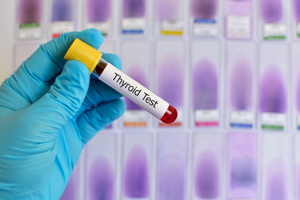 בדיקת דם לבלוטת התריס (צילום: Shutterstock)