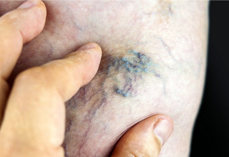 Swollen veins (illustration photo: shutterstock)