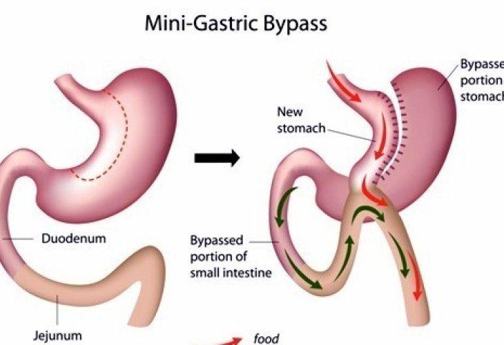 Stomach before and after bypass surgery (Photo: shutterstock)