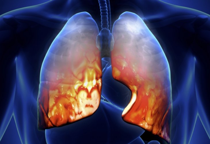 Pneumonia (Photo: shutterstock)