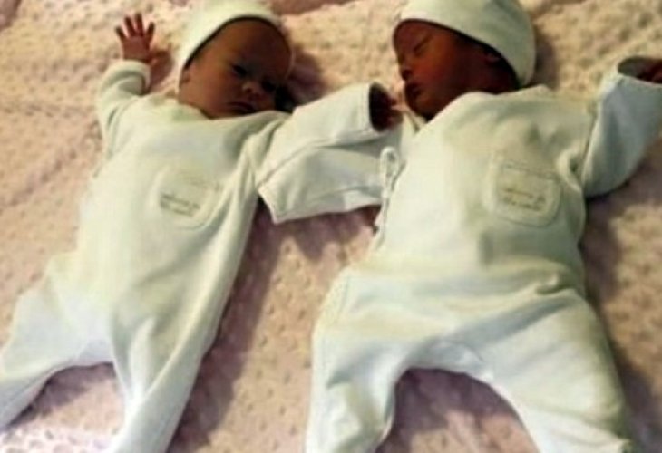 Twins Abigail and Isabel at birth (Photo: from YouTube) Twins Abigail and Isabel at birth (Photo: from YouTube)