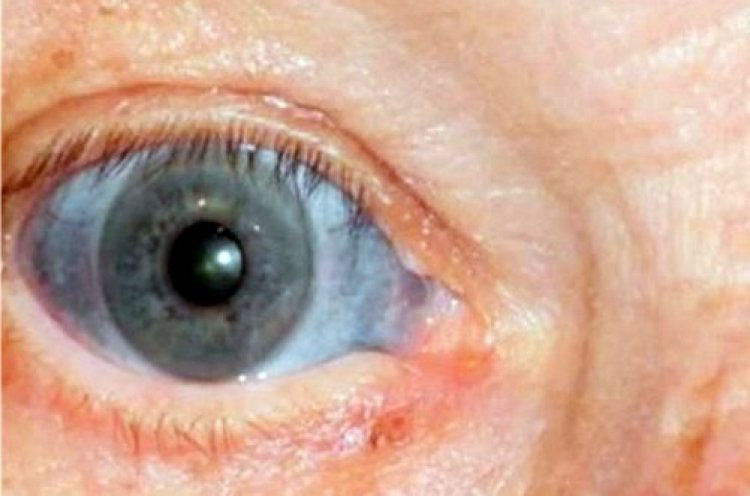 אישוני עיניו של הישיש שהפכו לכחולים (צילום: New England Journal))