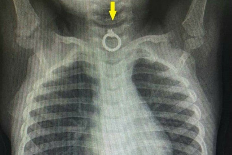 צילום רנטגן של הפעוט, עם העגיל (צילום: המרכז הרפואי זיו, צפת)