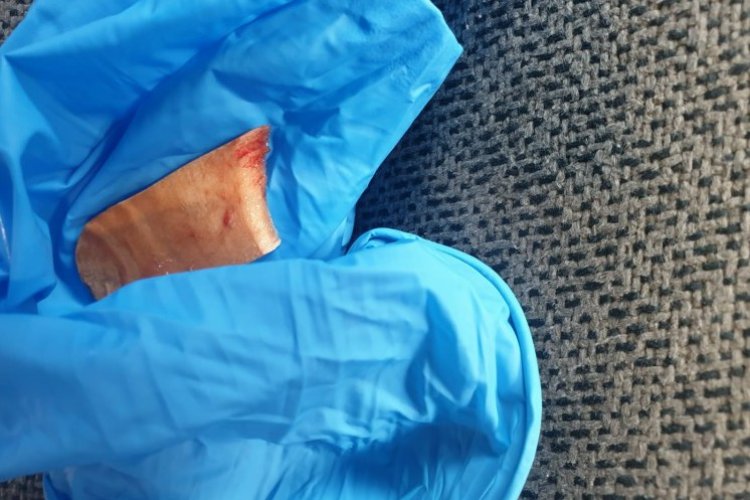 המקל הרפואי שחולץ מגרונו של התינוק (צילום: דוברות מד"א)