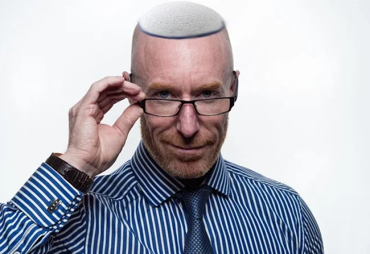 השתלת שיער | קרדיט: פיקסביי