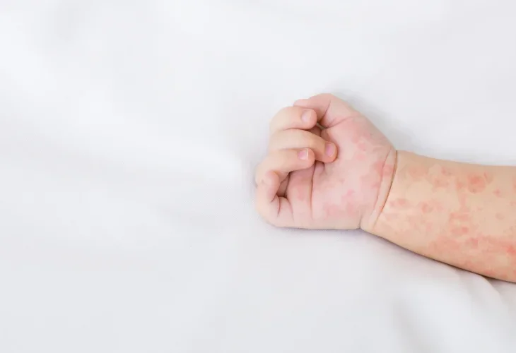 חצבת (קרדיט: shutterstock) חצבת (קרדיט: shutterstock)