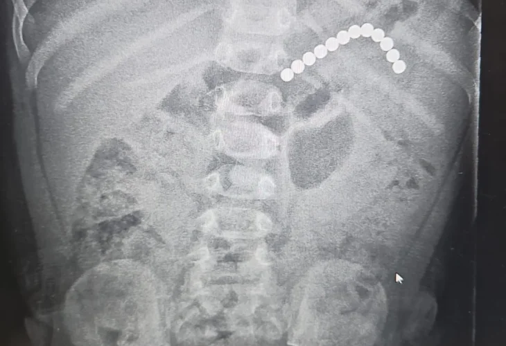 צילום מקיבתו של הפעוט (צילום: דוברות בית החולים אסותא, אשדוד)