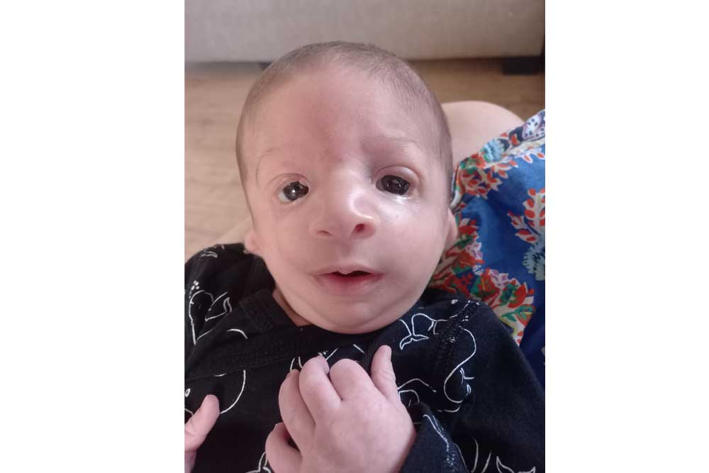 המאפיינים של תסמונת טריצ'ר קולינס מתבטאים אך ורק בשונות חיצונית
